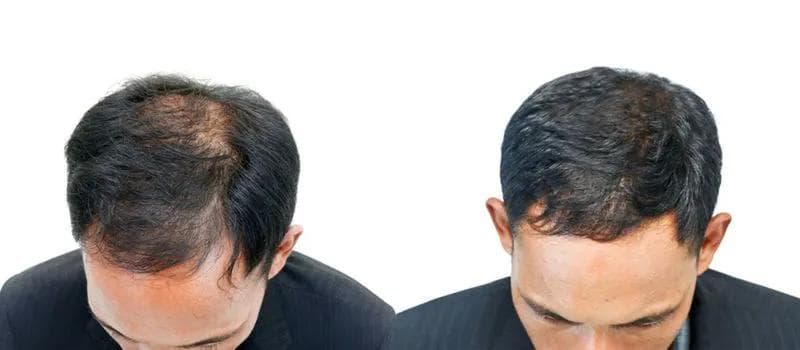 The Science Behind PRP Hair Restoration: Understanding the Treatment Process